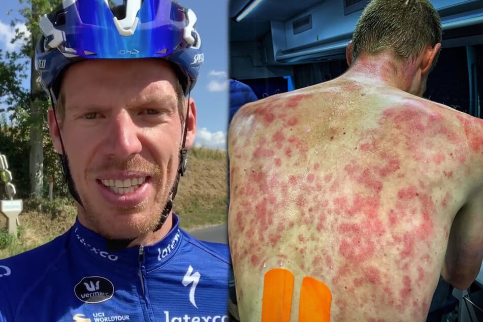 Der Radfahrer Tim Declercq (31) kann zum Glück schon wieder Scherze über seinen von Hagelkörnern schwer getroffenen Rücken machen.