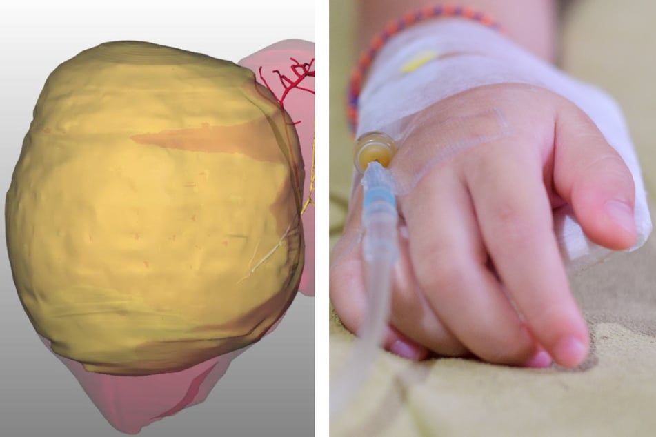 Mega-Tumor in der Leber: Baby wird Zwei-Kilo-Geschwulst entfernt