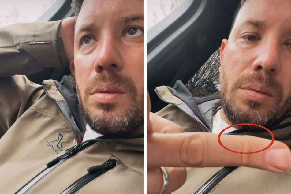 Bei Instagram hatte Florian Köster (34) seinen Fans die betroffene Stelle an seinem Finger gezeigt.