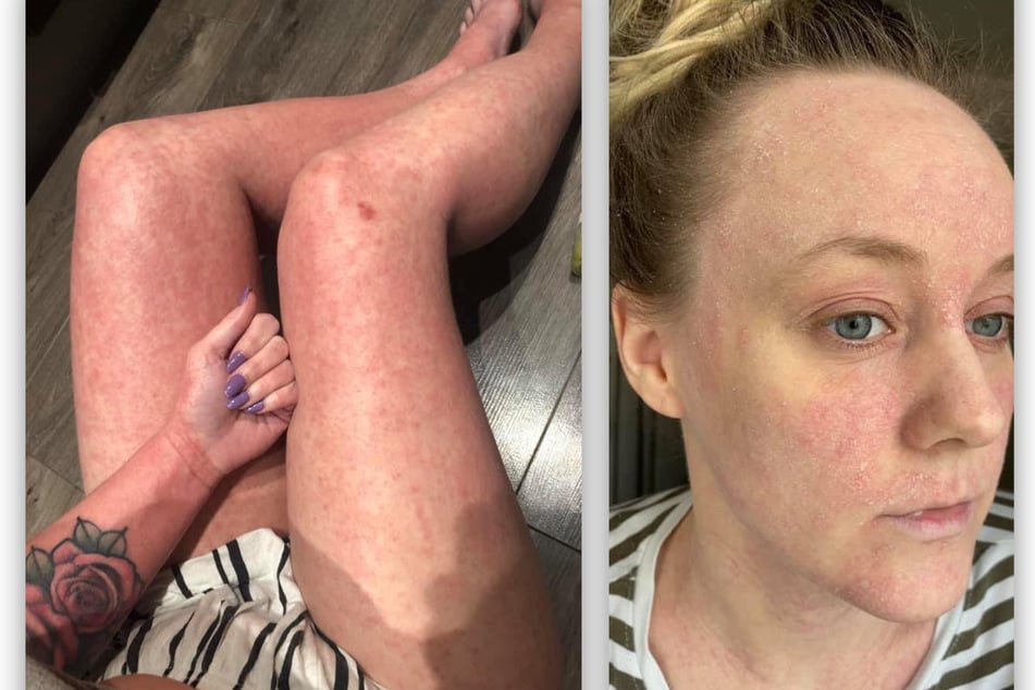 Bethany Norman hat offenbar Topical Steroid Withdrawal durch eine kortisonhaltige Creme entwickelt.