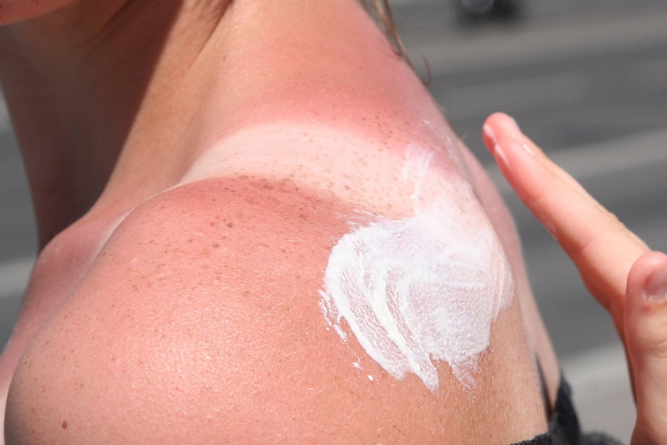 Sonnenbrand kann die äußere Hautschicht schädigen. Um dies zu verhindern, sollte stets auf den richtigen Lichtschutzfaktor geachtet werden.