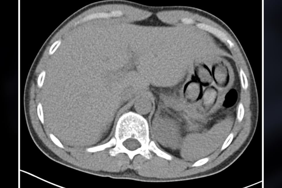 Eine Röntgenaufnahme seines Magens bestätigte den Verdacht der Beamten: Der Niederländer hatte insgesamt sieben Bodypacks mit Kokain verschluckt.