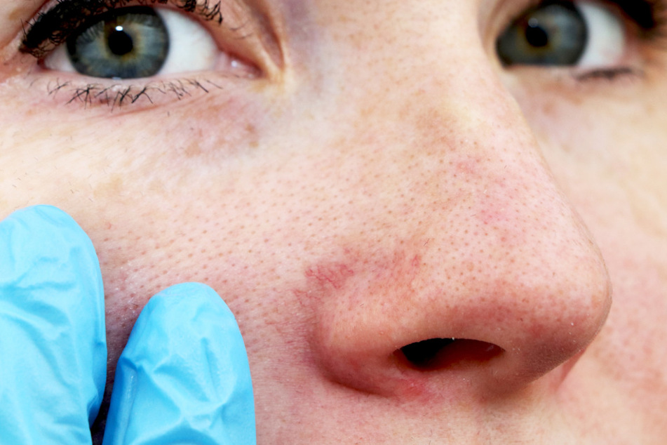 Neuen Erkenntnissen zufolge tritt das Coronavirus offenbar durch die Nase und auch die Augen in den Körper ein.