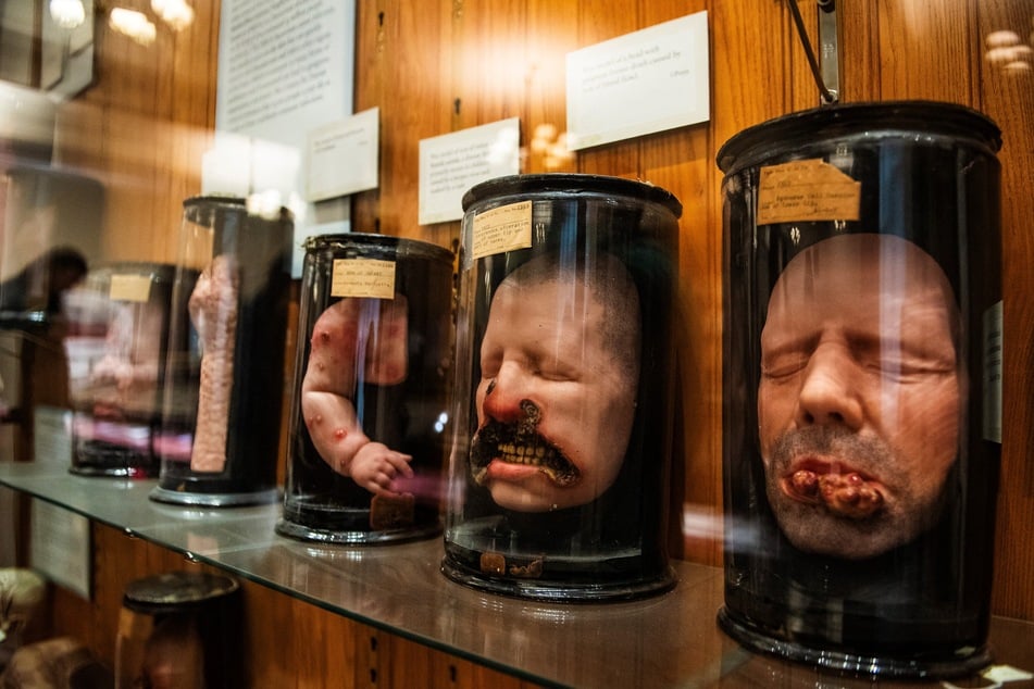 Wax moulding of patients suffering from various skin and facial diseases are on display in the main gallery at the Mutter Museum Historical Medical Library.
