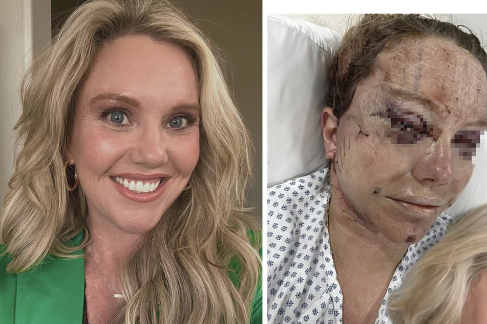 Auch, als LeAnn Hawks (45) Wunden rund vier Monate nach der OP wieder verheilt sind, bekam sie einen Schrecken, als sie kurz nach der Operation ihr Aussehen sah.