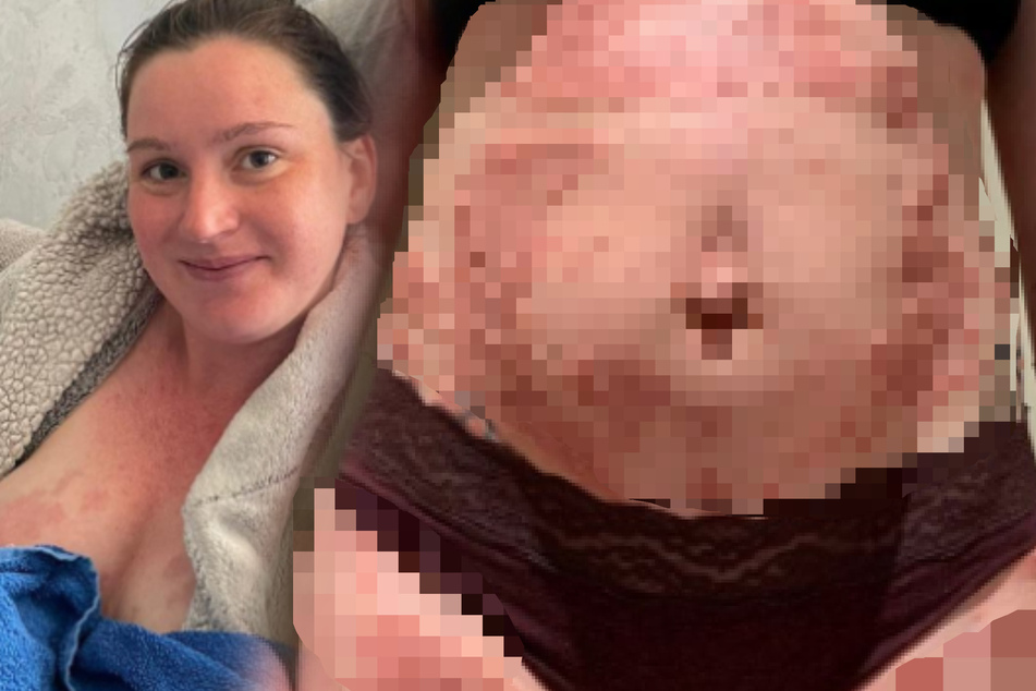 Juckende Pusteln und Blasen am ganzen Körper! Junge Mutter reagiert allergisch auf ihr Baby
