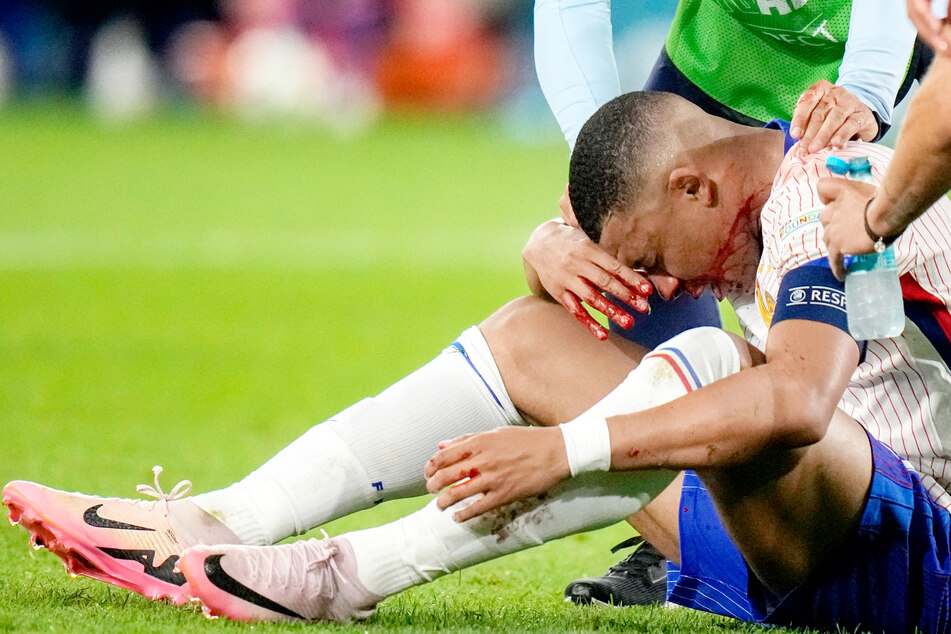 Frankreichs Superstar Kylian Mbappé (25) muss nach seinem Nasenbeinbruch operiert werden. Allerdings nicht sofort.