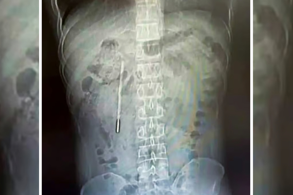 Im Zwölffingerdarm eines 32-Jährigen haben Ärzte in China ein Quecksilberthermometer entdeckt.