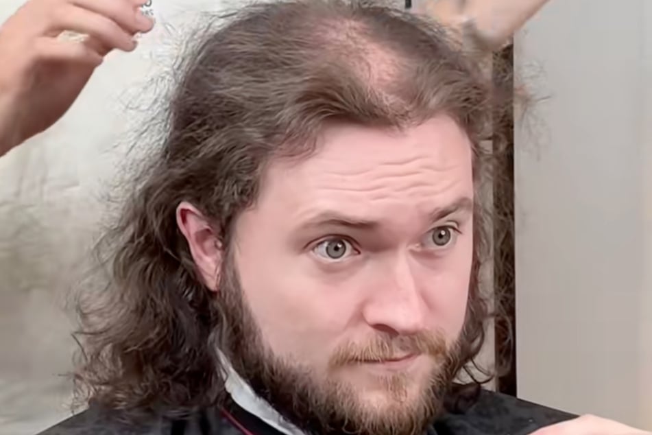 Mit nur 27 Jahren leidet dieser Mann unter Haarausfall.