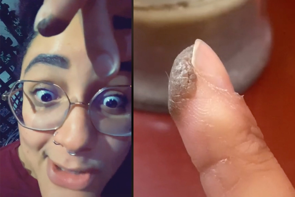 Texas woman claims to have pubic hair growing on her finger