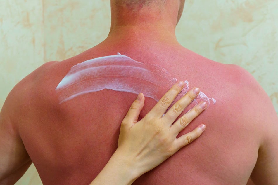 Laut Krebsinformationsdienst des Deutschen Krebsforschungszentrums ist der wichtigste Risikofaktor für fast alle Hautkrebsarten UV-Strahlung (ultraviolette Strahlung).