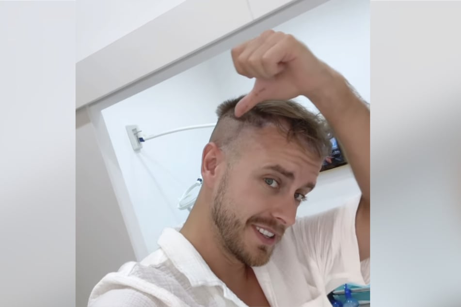 Die ersten Schnitte sind gesetzt: Influencer Julian Claßen (31) präsentiert stolz und aufgeregt den Beginn seiner Haartransplantation.