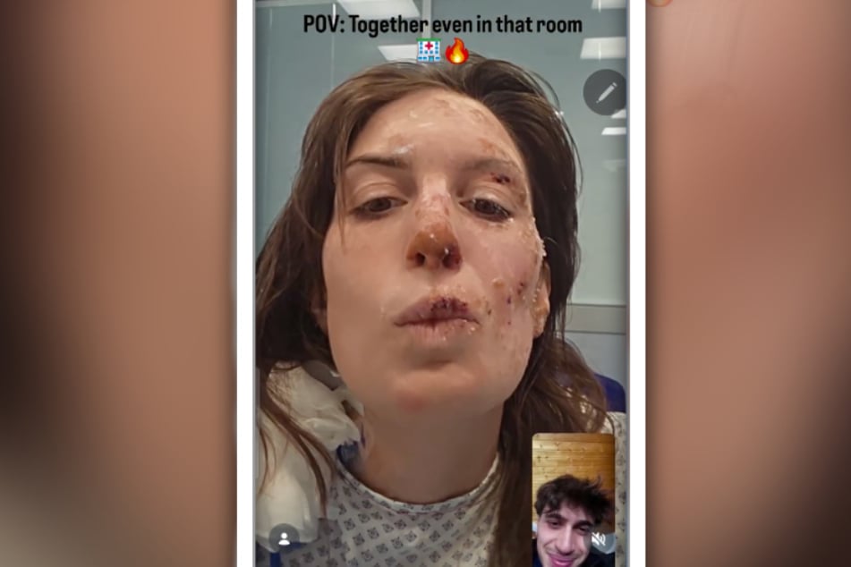 Die 29-Jährige zeigt ihre Brandwunden im Gesicht.