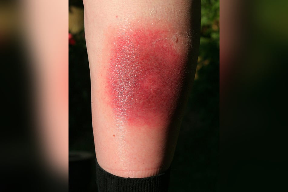 Klares Warnzeichen für Borreliose: Die sogenannte Wanderröte kann Tage oder Wochen nach einem Zeckenstich auftreten.