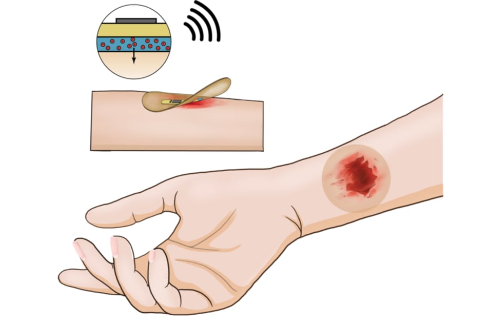 Scientists at Stanford University have created a "smart" bandage that uses electrical stimulation for fast healing.