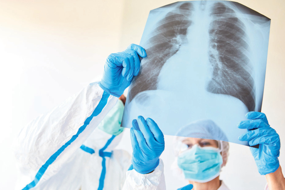 Tuberkulose ist auf dem Röntgenbild sichtbar. Die Krankheit ist jetzt bei einem Bewohner einer Pflegeeinrichtung bei Weißwasser diagnostiziert worden. (Symbolbild)