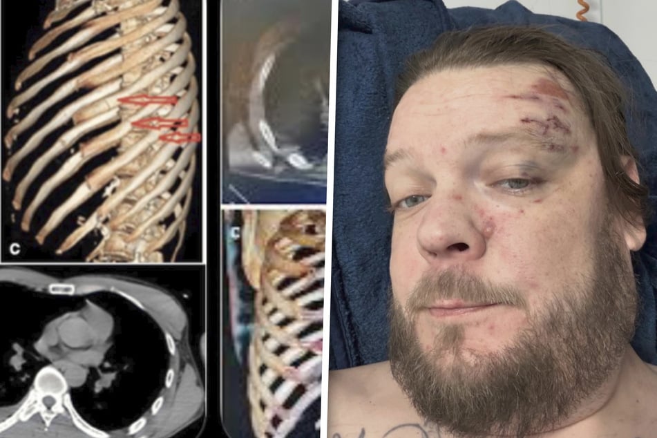 Der Reality-Star ist deutlich gezeichnet. Röntgenbilder zeigen seine gebrochenen Rippen.