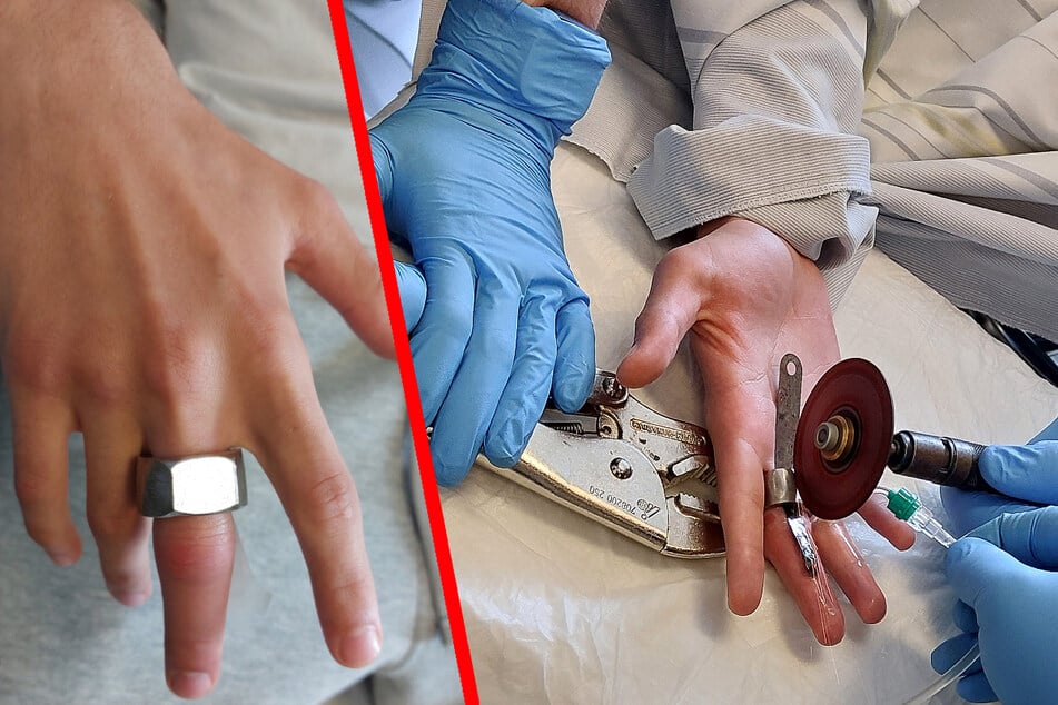 Durch seinen "Ring" schwoll der Finger so an, dass der 15-Jährige ins Krankenhaus musste.