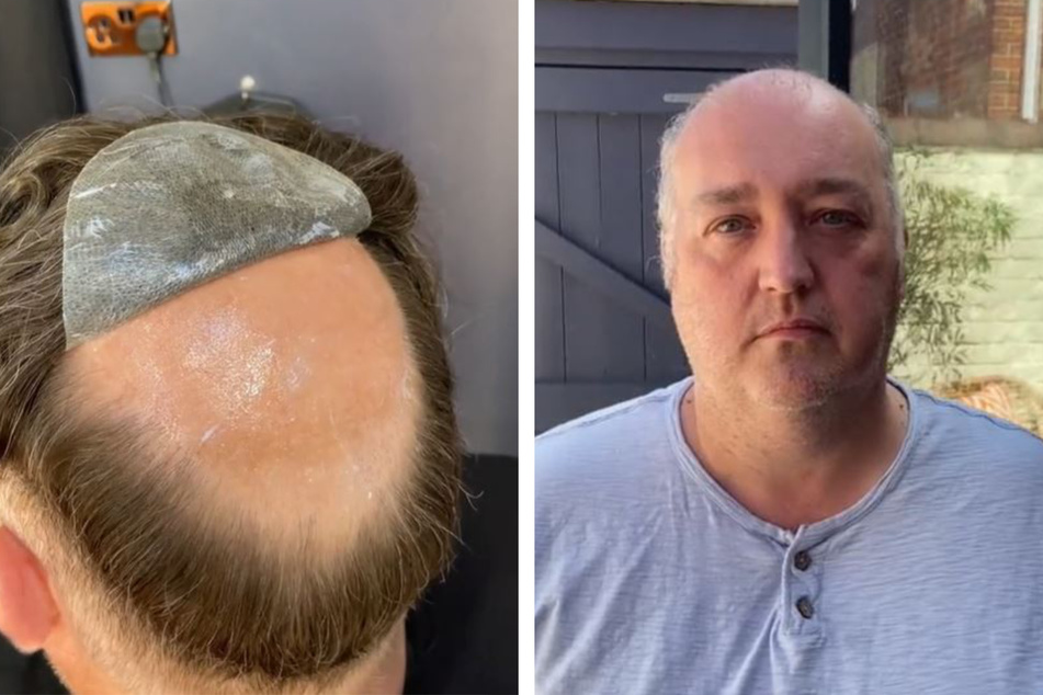 Mann mit Glatze bekommt Toupet: Als er das Ergebnis sieht, ist er fassungslos