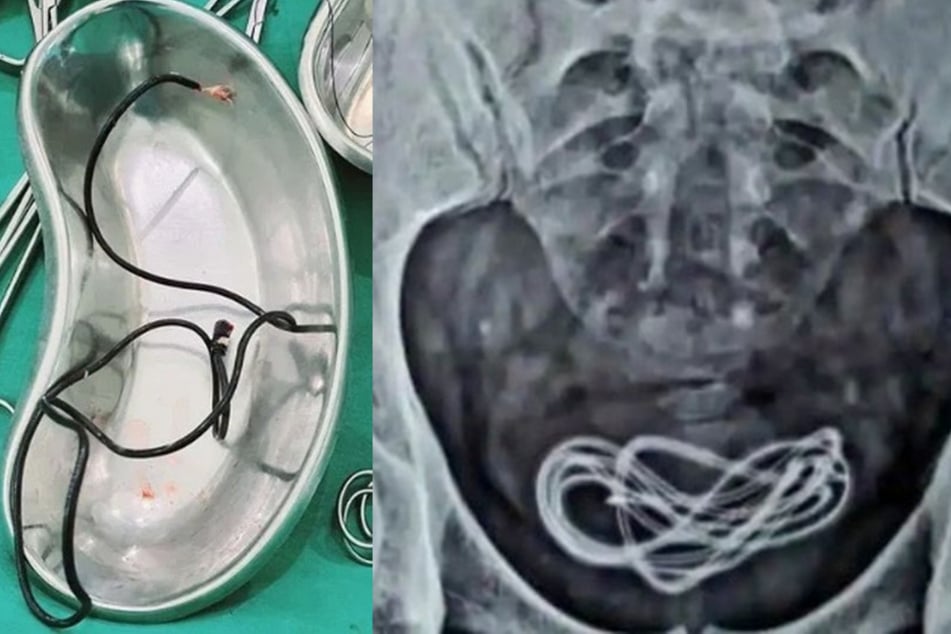 Mit einer Operation konnten die Ärzte das Kabel aus dem Mann herausholen.