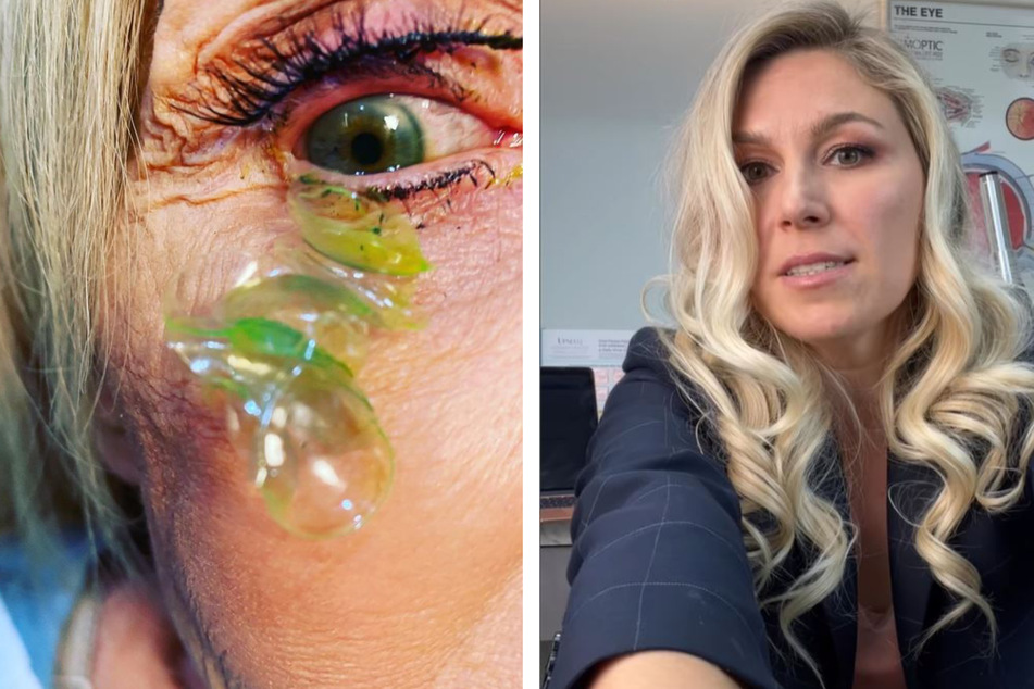 Insgesamt 23 Kontaktlinsen will Augenärztin Dr. Katerina Kurteeva aus dem rechten Auge ihrer Patientin gezogen haben. Offenbar brauchte die ältere Dame für ihr linkes Auge keine Sehhilfe.