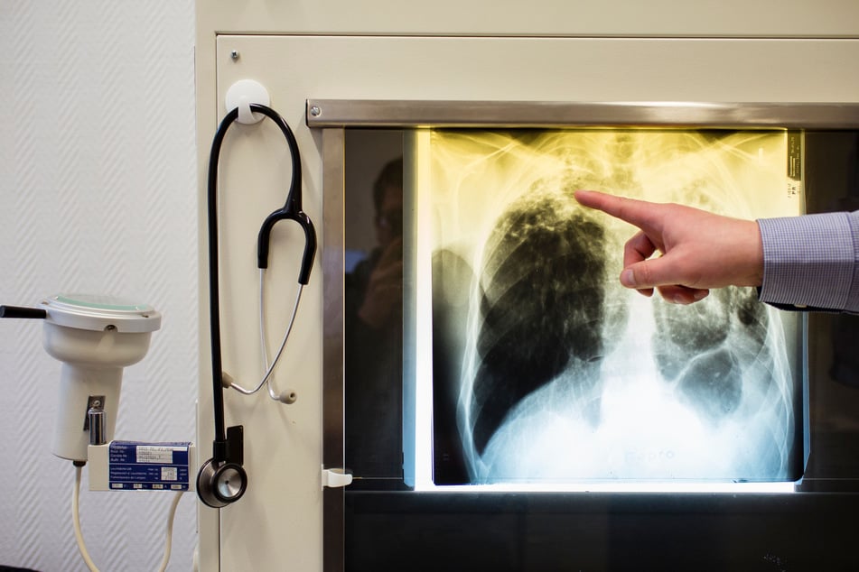 Dresden: Keine weiteren Tuberkulose-Fälle in Dresden: Darum gibt es trotzdem keine Entwarnung