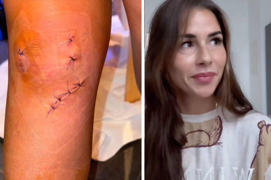 Schon einmal sah Sarah Engels (32) Knie so heftig lädiert aus wie auf dieser Aufnahme von Februar. Diesmal ist es zum Glück nur ein kleiner Sehnenriss in der Kniescheibe, wie sie am Donnerstag berichtete.