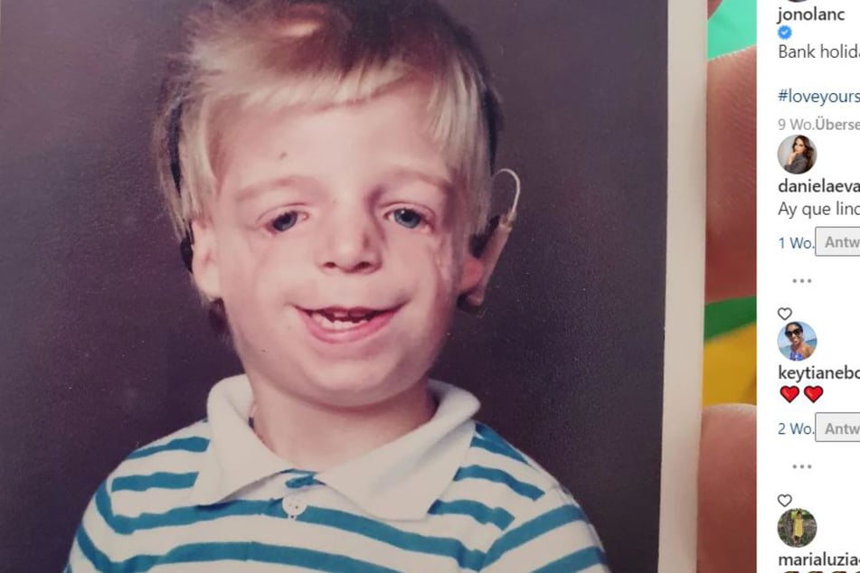 Jono Lancaster kam mit dem Treacher-Collins-Syndrom zur Welt. Schon als Kleinkind brauchte er ein Hörgerät.