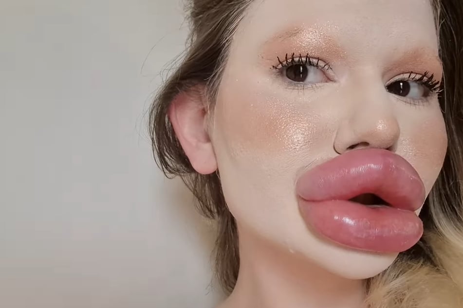 Ningún dentista quiere ayudarla: mujer con los labios más grandes del mundo está "completamente decepcionada"