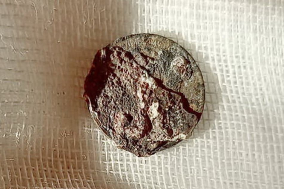 The ancient coin retrieved from the patient's (59) nose.