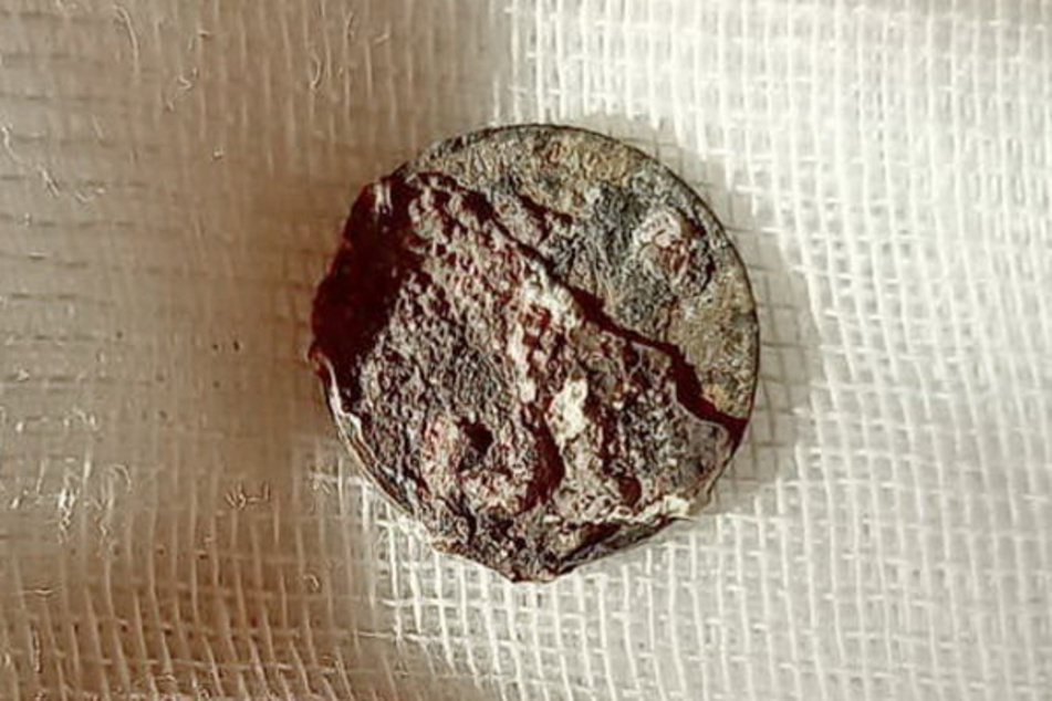 The ancient coin retrieved from the patient's (59) nose.