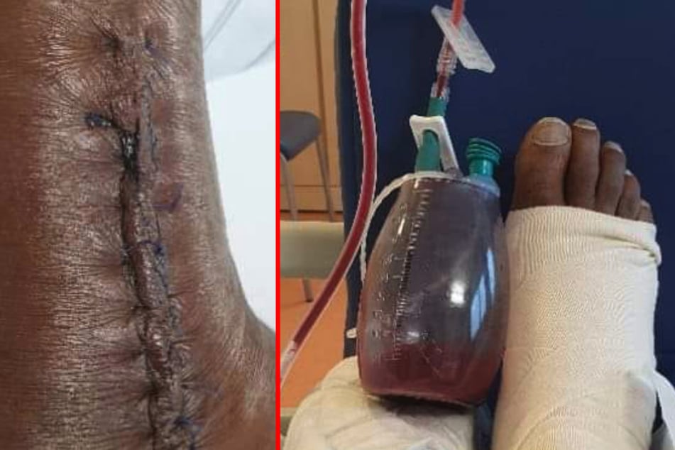 Der gebrochene Fuß von Ehemann Mark Kitau musste im Krankenhaus operiert werden.