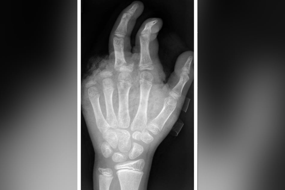 So sieht es aus, wenn das Böllern schiefgeht: Die Röntgenaufnahme zeigt eine Hand, an der zwei Finger fehlen.