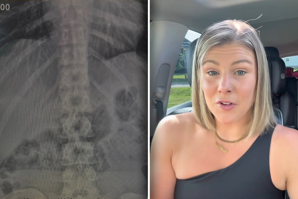 Kait Moseder (31) hat kürzlich einen ihrer AirPods geschluckt, ließ sich Tage später sogar röntgen.