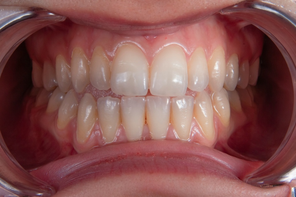 Ever wondered why our teeth are so sensitive to pain or even just cold drinks? It might be because they first evolved for a very different purpose than chewing half a billion years ago, a new study suggested this week.