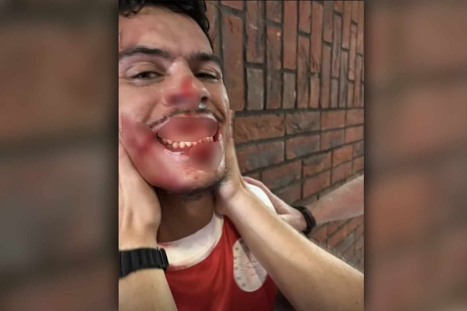 Bilder im Netz zeigen das blutige Gesicht von Quiermo Dumay (25) nach der Attacke.