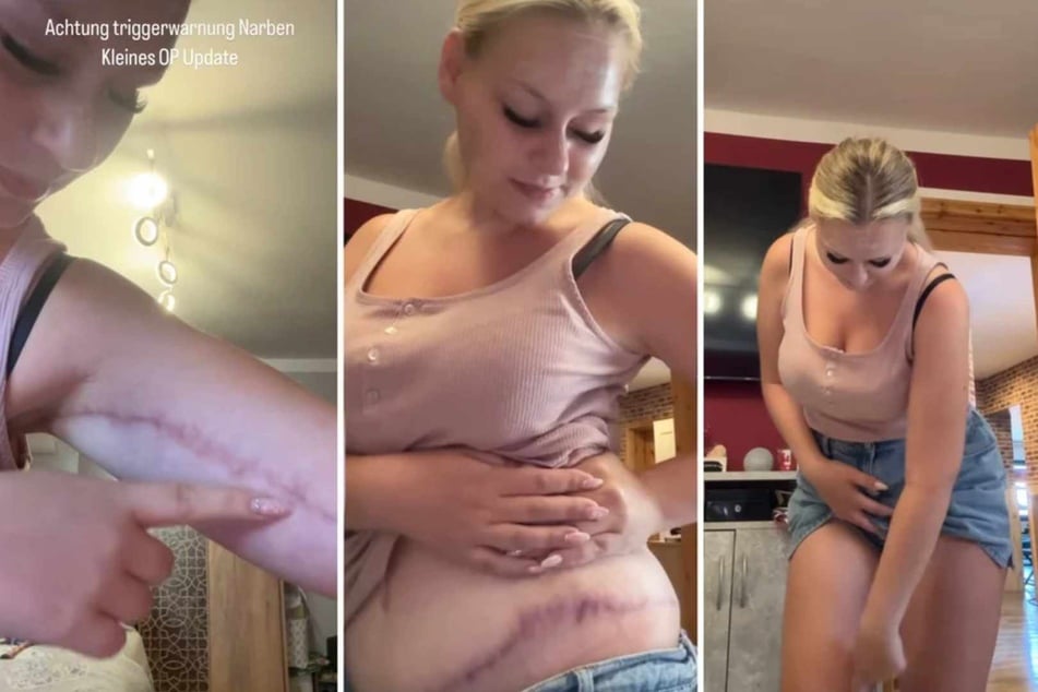 Sarah-Jane zeigte nach der Bauchdecken- und Oberarmstraffung im vergangenen Jahr auf Social-Media offen ihre Narben. (Archivfoto)