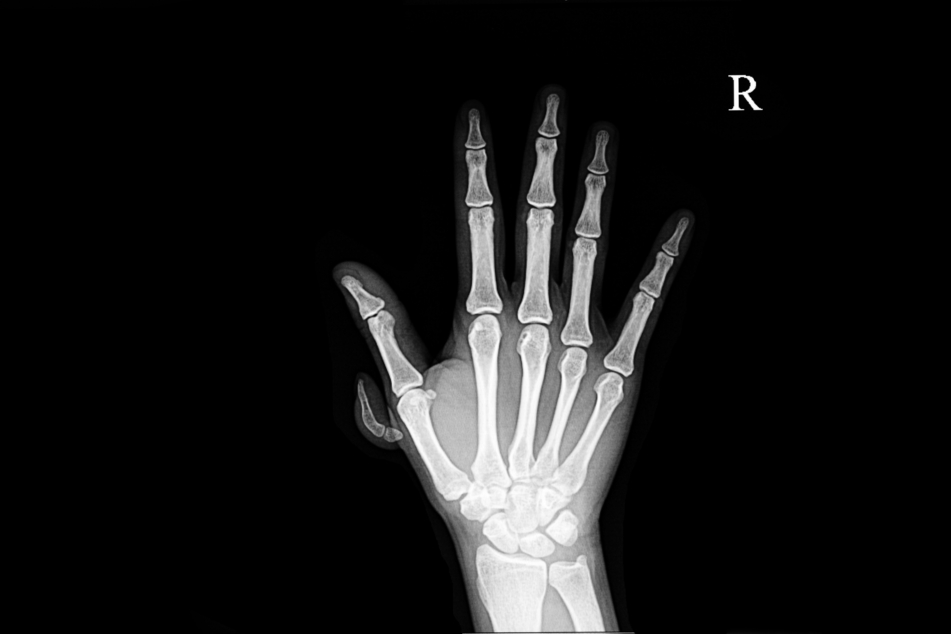 Polydactyly is one of the most common congenital malformations.