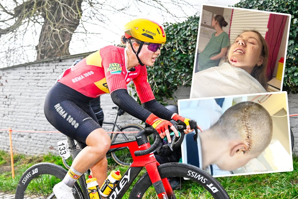 Hirnblutung nach Sturz bei Klassiker: Jetzt zeigt Radsport-Talent seine krassen Wunden