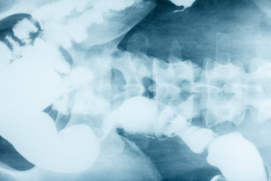 Mann wacht mit schrecklichen Schmerzen auf: Was Ärzte dann in seinem Enddarm finden, ist völlig irre