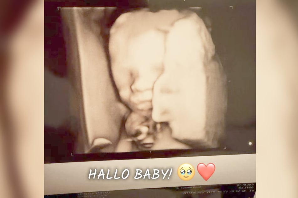 Bei der jüngsten Kontroll-Untersuchung in der 25. Schwangerschaftswoche wurde ein 3D-Ultraschallbild des ungeborenen Babys angefertigt.