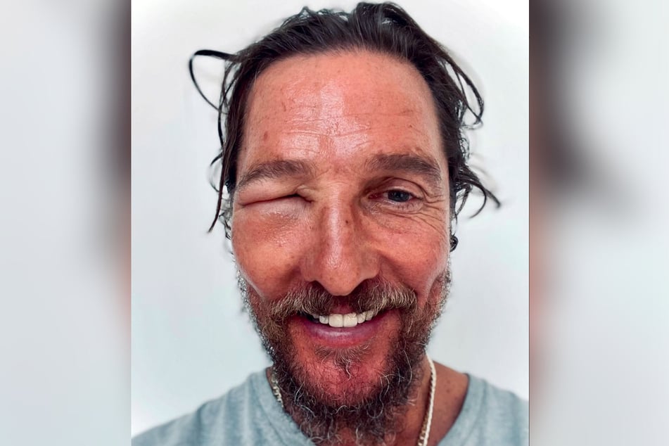 Sieht er denn noch richtig? Den Schauspieler Matthew McConaughey (54) hat offenbar eine Biene gestochen.