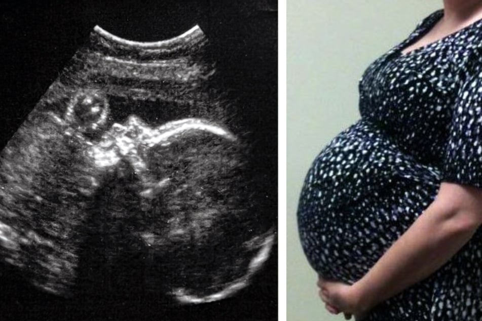 Erste erfolgreiche Operation im Mutterleib: Fötus kann noch vor der Geburt gerettet werden!