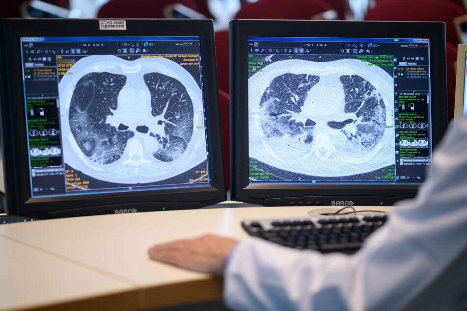 Auf zwei Monitoren sind am Klinikum Stuttgart Computertomographieaufnahmen der Lunge eines Covid-19-Patienten zu sehen. Die linke Aufnahme wurde zu Beginn der Behandlung der Coronainfektion angefertigt - die rechte Aufnahme 13 Tage später.