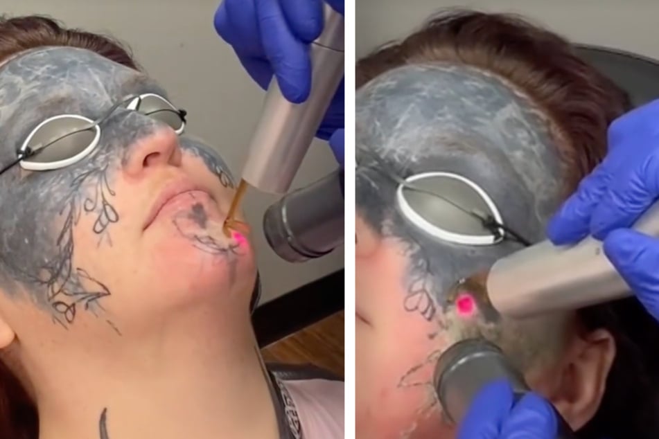Taylor has completed her first laser session, but it may take years before her face is truly tattoo free.