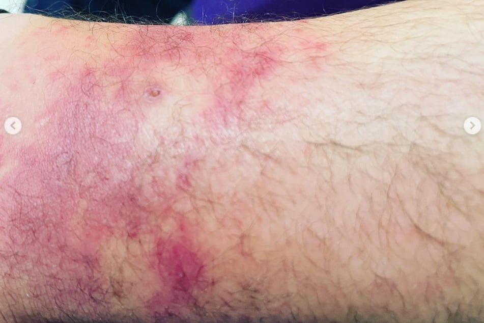 Gabe Lustman's leg after the brown recluse spider bite.
