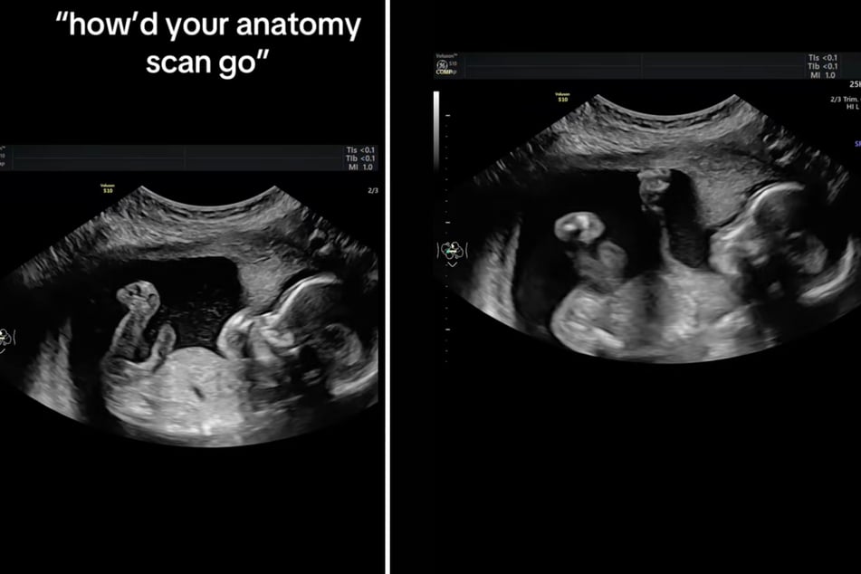 Beim Ultraschall dieses ungeborenen Babys ereignete sich ein lustiger Moment, der den Eltern nicht entging.