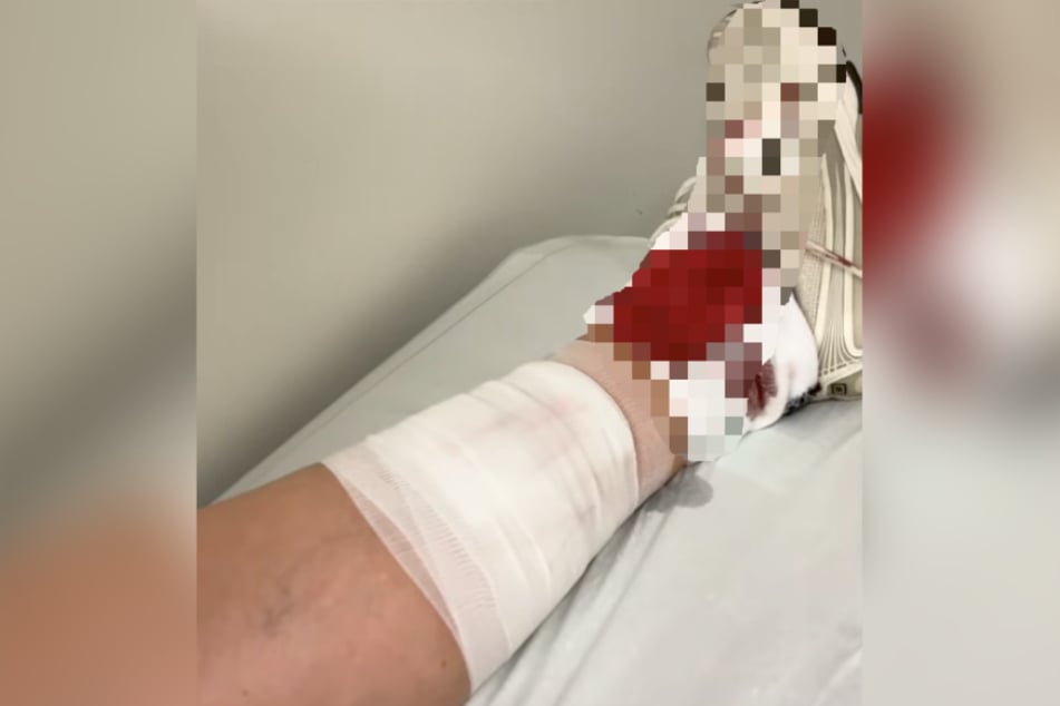 Schuh und Socken der Hamburgerin waren nach dem Zwischenfall blutdurchtränkt.