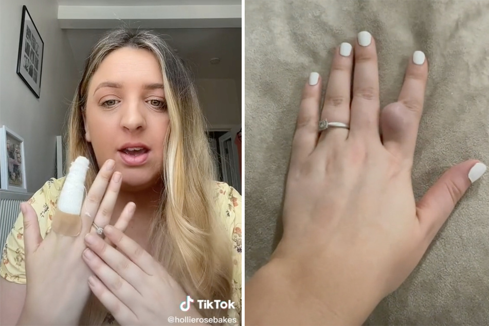 TikToker with "pregnant finger" shares her bizarre health journey