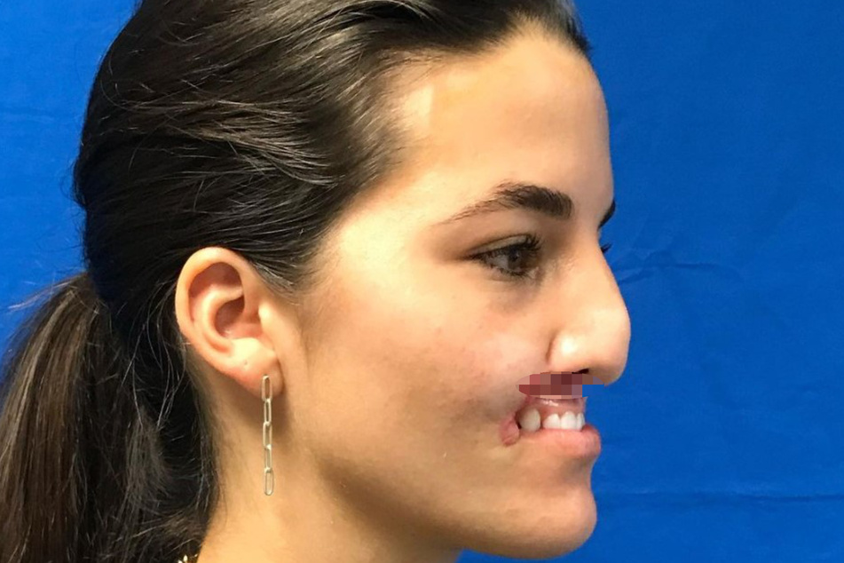 Brooklin Khoury (24) verlor am 3. November 2020 einen Teil ihrer Nase und die komplette Oberlippe.